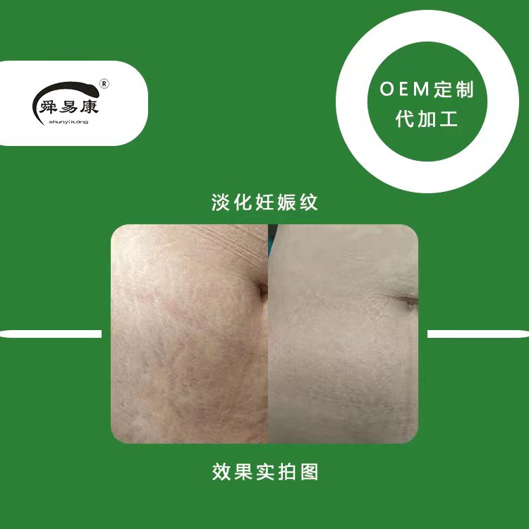 疤痕修复凝胶疤痕消妊娠纹克星妈妈的福音舜易康疤痕修复凝胶